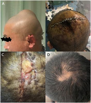 A primary Rosai-Dorfman-Destombes disease of the scalp: case report and literature review